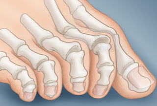 webmd_rf_photo_of_claw_toe.jpg