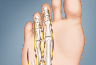 webmd_rf_photo_of_mortons_neuroma.jpg