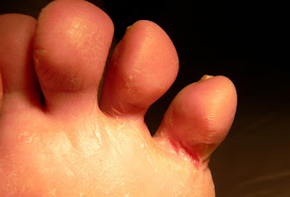 princ_rm_photo_of_athletes_foot.jpg