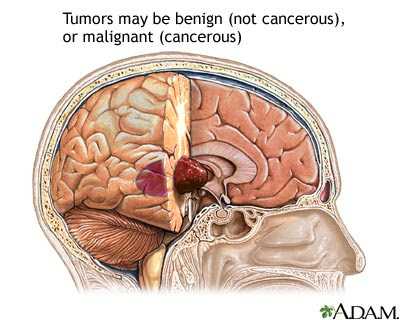 Brain_Tumors.jpg