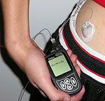 150px-Insulin_pump_with_infusion_set.jpg