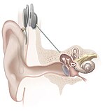 150px-Cochlear_implant.jpg
