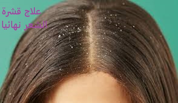 علاج قشرة الشعر نهائيا