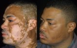 vitiligo-before-and-after-treatment-6.jpg