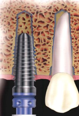 implant02.JPG