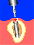 implant6.gif