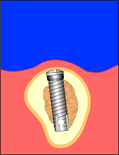 implant4.gif