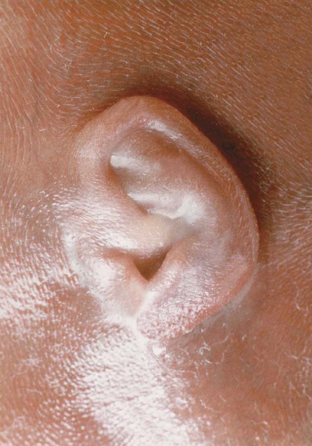 fig13ear3.5mos.jpg