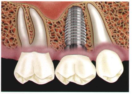 implant01.JPG