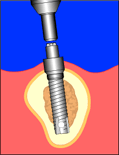 implant7.gif