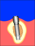 implant8.gif