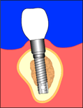 implant9.gif