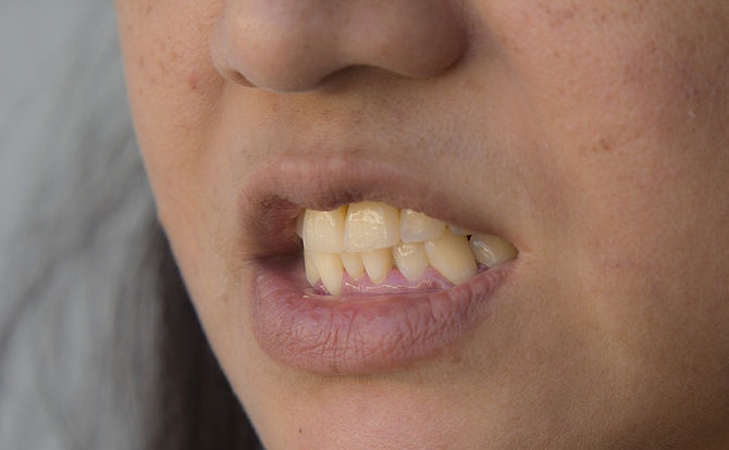 670px-Whiten-Your-Teeth-with-Banana-Peel-Step-3Bullet2.jpg