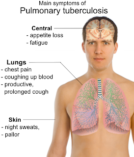 pulmonary_tuberculosis_symptoms.png