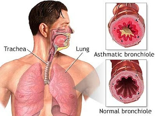 Bronchial-Asthma.jpg