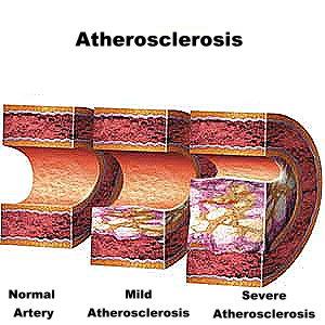 Atherosclerosis_Definition_Treatment_Causes+_Risk_Factors_Symptoms_Prevention.jpg