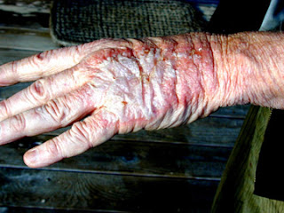 chemotherapy-chemo-side-effects-burns.jpg